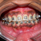 Orthodontic Braces Treatment in Kalyan